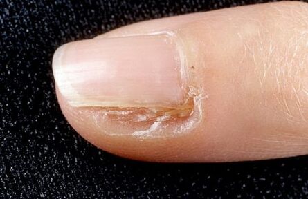 ciuperca unghiilor inflamate